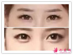 玻尿酸豐臥蠶注意事項(xiàng)_玻尿酸豐臥蠶哪些不適合？