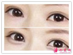 玻尿酸豐臥蠶護(hù)理_玻尿酸豐臥蠶注意事項(xiàng)有哪些？