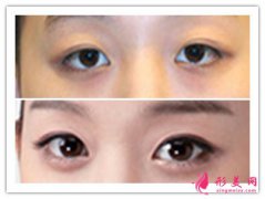 玻尿酸豐臥蠶注意事項(xiàng)_玻尿酸豐臥蠶風(fēng)險(xiǎn)大嗎？