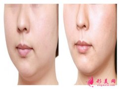 面部吸脂_面部吸脂瘦臉要多久恢復(fù)？