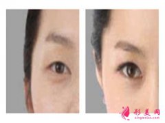 四維韓式重瞼術(shù)_什么是四維韓式重臉術(shù)？