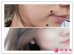 激光點(diǎn)痣有多疼-激光點(diǎn)痣疼嗎？