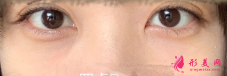 激光治療黑眼圈后要如何護(hù)理