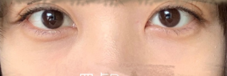 激光治療黑眼圈后要如何護理