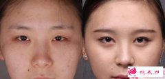 開內(nèi)眼角手術(shù)適合人群_開內(nèi)眼角手術(shù)適合哪些女性？
