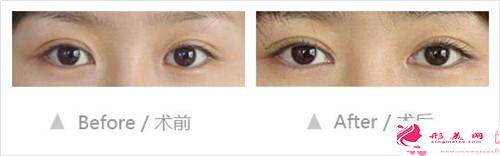 開內(nèi)眼角手術(shù)適合人群_開內(nèi)眼角手術(shù)適合哪些女性？