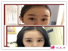 韓式雙眼皮手術(shù)-韓式雙眼皮效果好不好？