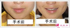 酒窩成形術(shù)-酒窩形成術(shù)安全嗎？