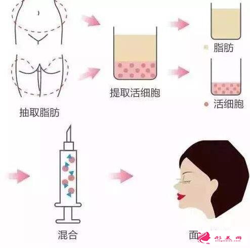 做自體脂肪填充后遺癥