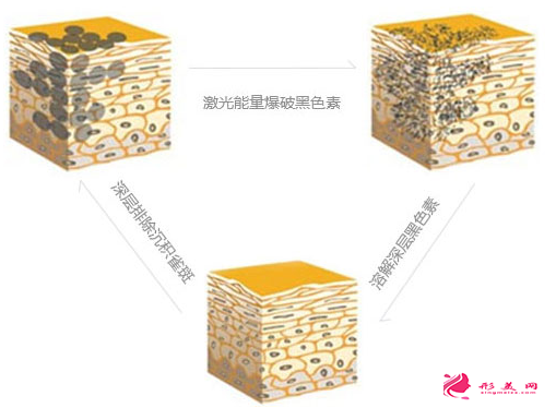怎么去雀斑比較好