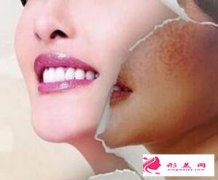 皮秒祛斑恢復(fù)過(guò)程圖