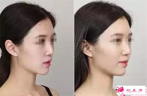 豐蘋果肌的方法_豐蘋果肌什么方法最好？