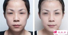 剛填充額頭需要注意些什么額頭填充注意事項(xiàng)