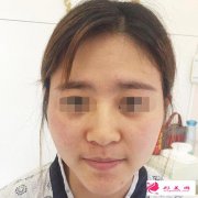 在昆明美立方醫(yī)療美容醫(yī)院做完膨體隆鼻后 顏值跟氣質(zhì)發(fā)生了很大