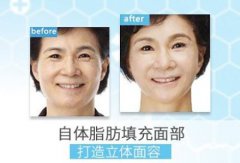 自體脂肪填充面頰大致須要多少錢？