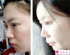 額頭手術(shù)額頭整形有幾種方案？
