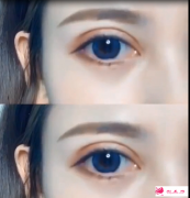 哈爾濱雙眼皮做的好的醫(yī)院醫(yī)生