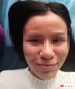 武漢愛思特做下頜角整形的價格是多少？