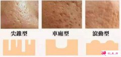 如何修復(fù)臉上痘痘的凹坑