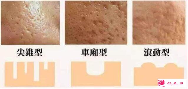 如何修復(fù)臉上痘痘的凹坑