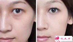 去眼袋價(jià)格，去眼袋大概要多少錢？