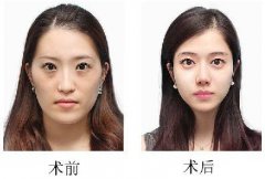 面部磨骨對于自身有損害嗎