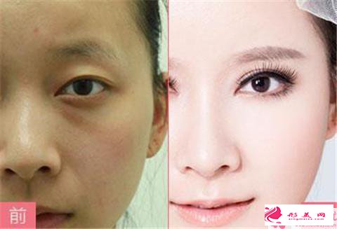 顴骨降低術(shù)的適用人群_哪些人不能做顴骨降低術(shù)
