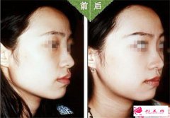顴骨降低術(shù)的適用人群，哪些人不能做顴骨降低術(shù)