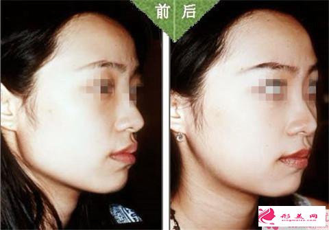 顴骨降低術(shù)的適用人群_哪些人不能做顴骨降低術(shù)