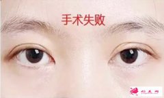 雙眼皮修復(fù)手術(shù)好不好