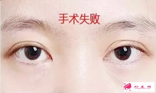 雙眼皮修復(fù)手術(shù)好不好