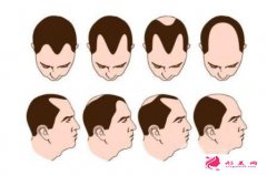 微針植發(fā)和普通植發(fā)，開刀取發(fā)和點狀取發(fā)都是什么意思?