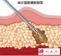 抽脂減肥的大致過程及術后癥狀