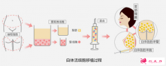 自體脂肪填充面部有硬結怎么辦?