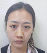 西京醫(yī)院做的隆鼻手術(shù)過程分享