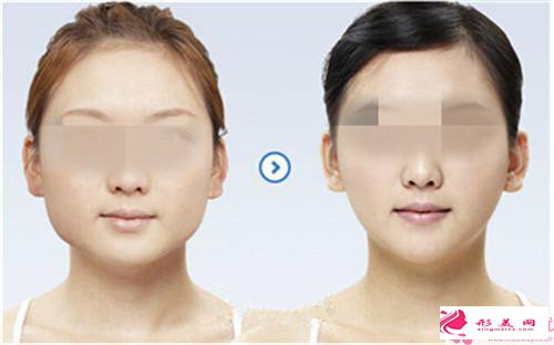 改臉型手術(shù)的體現(xiàn)_改臉型手術(shù)整形會(huì)不會(huì)痛?
