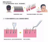 做植發(fā)整形術后頭頂?shù)拿l(fā)多長時間生出來?