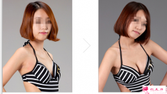 自體脂肪隆胸會導(dǎo)致變異嗎？