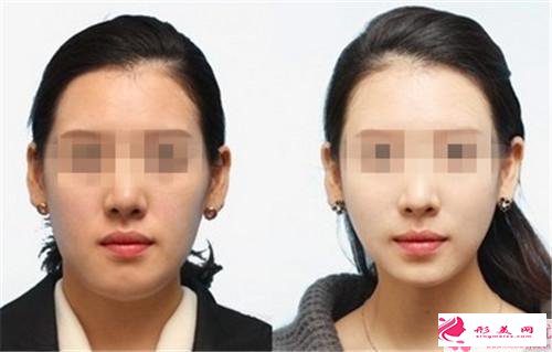 瘦臉的方法_怎樣才能趕走嬰兒肥?