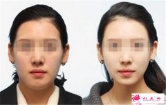注射瘦臉針需要注意些什么？