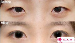 埋線雙眼皮手術(shù)過后一般多久可以恢復(fù)？