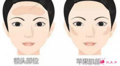 脂肪填充面部的大概過程