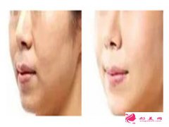 駝峰鼻矯正之后自然嗎？