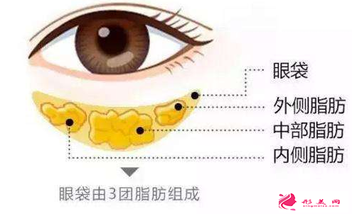 手術切除眼袋后眼眶凹陷怎么回事