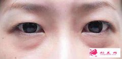 手術(shù)切除眼袋多少錢?