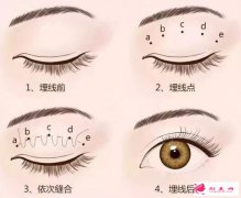 埋線雙眼皮脫線了怎么辦?