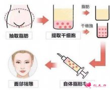 自體脂肪填充面部要注射幾次才有效果？