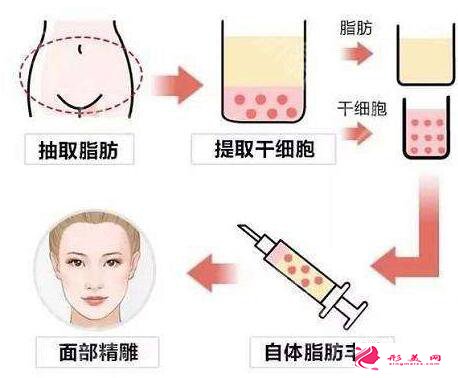 自體脂肪填充面部要注射幾次才有效果