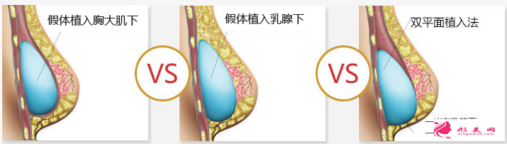 假體隆胸有年齡要求嗎