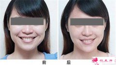 自體脂肪填充面頰要多少錢？